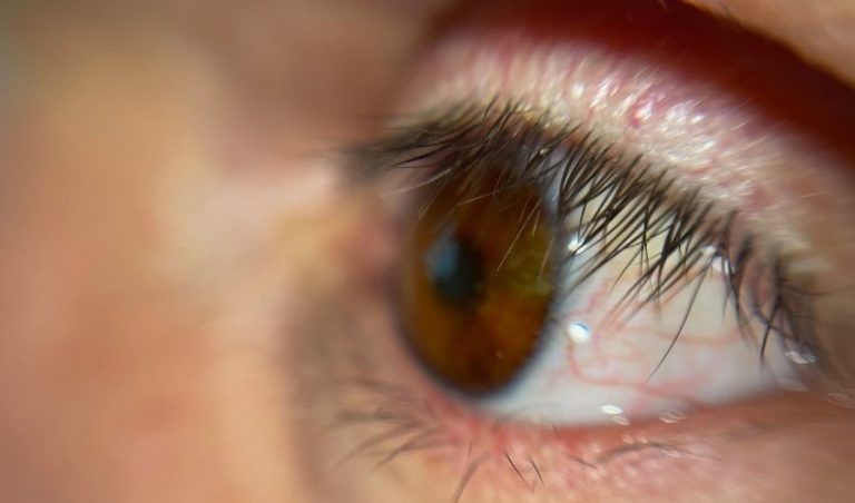 پرینت سه بعدی نخستین پروتز چشم