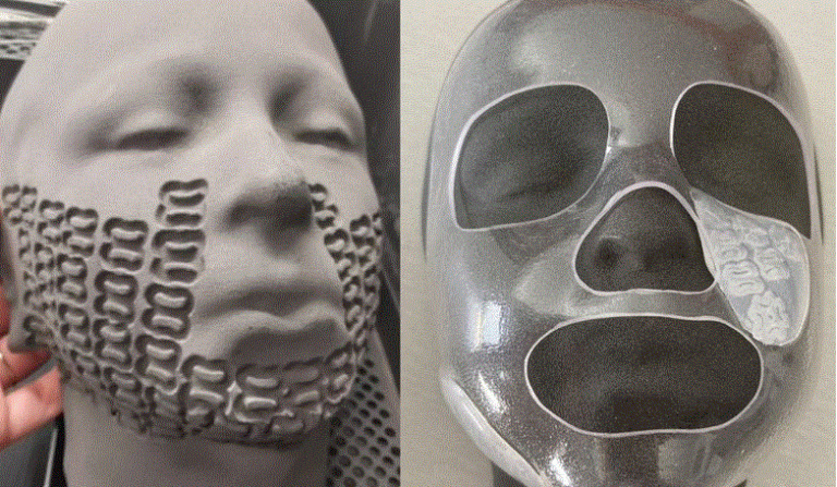 پرینت سه بعدی ماسک برای درمان سوختگی شدید در کودکان